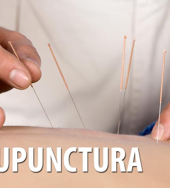Forme de medicina alternativa – acupunctura